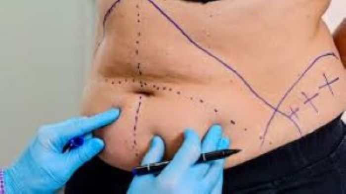 Tummy Tuck after few years